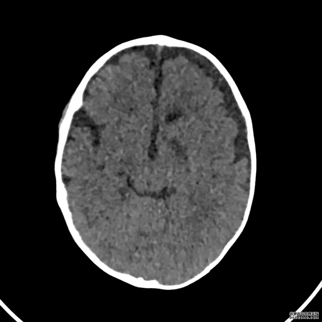 【病例】低血糖性脑病1例MR影像-2