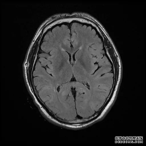 【病例】低血糖性脑病1例MR影像-18