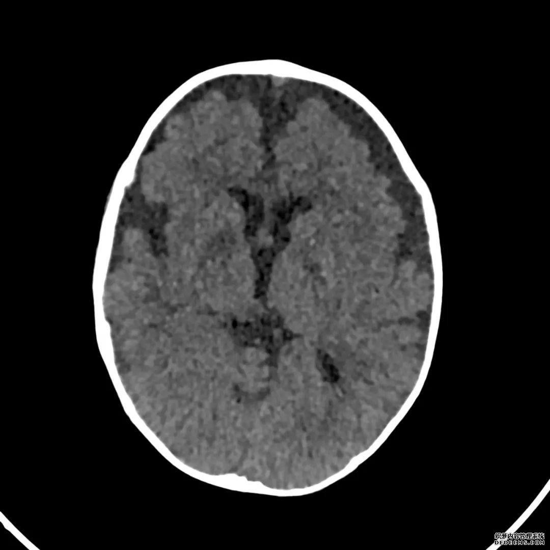 【病例】低血糖性脑病1例MR影像-4