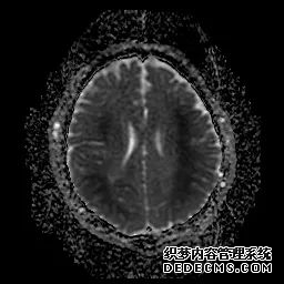 【病例】低血糖性脑病1例MR影像-24