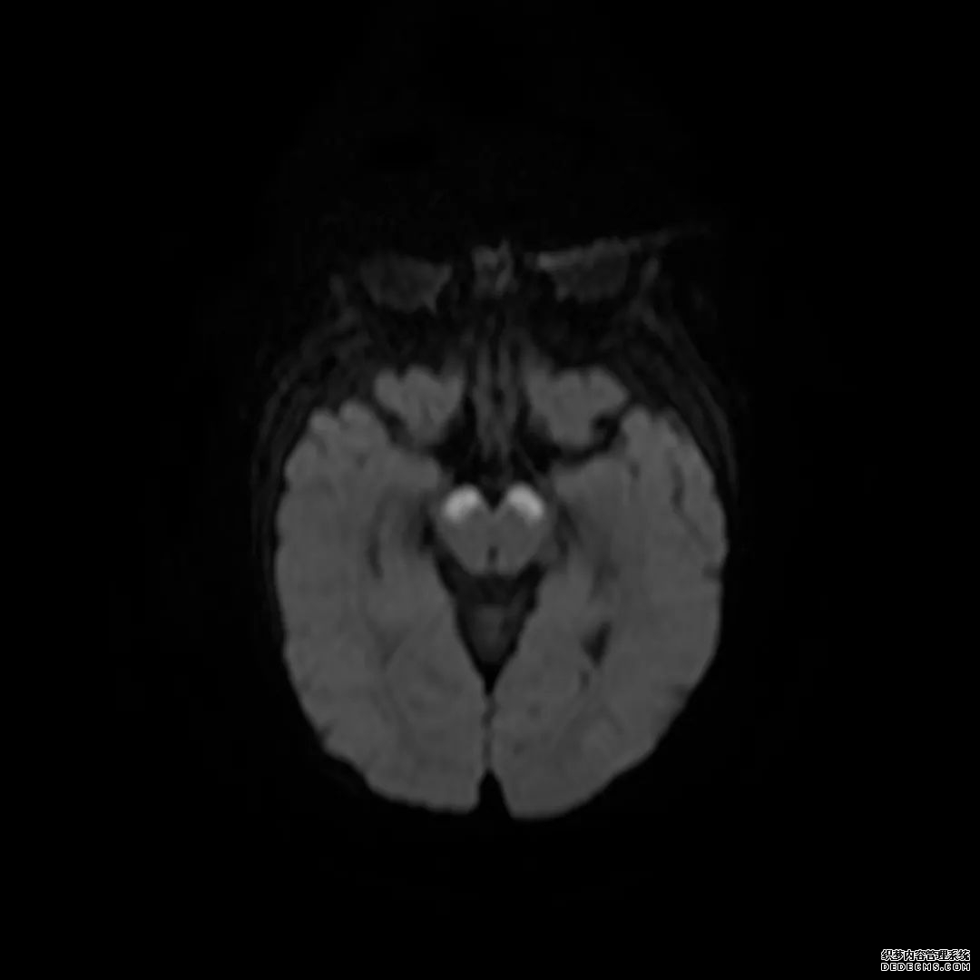 【病例】低血糖性脑病1例MR影像-12