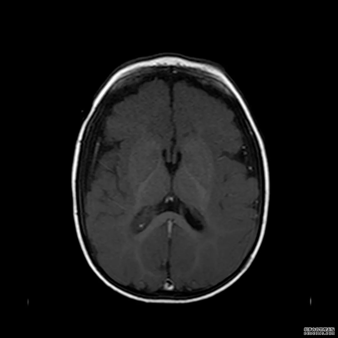 【病例】低血糖性脑病1例MR影像-7