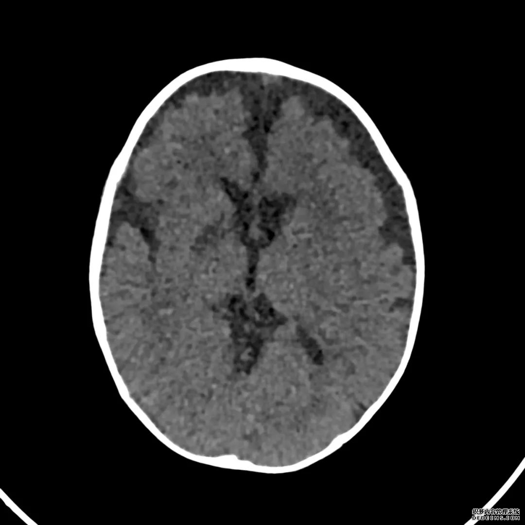 【病例】低血糖性脑病1例MR影像-5