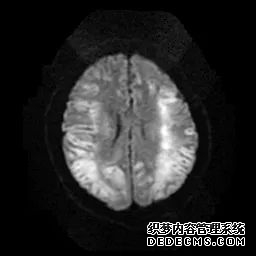 【病例】低血糖性脑病1例MR影像-22