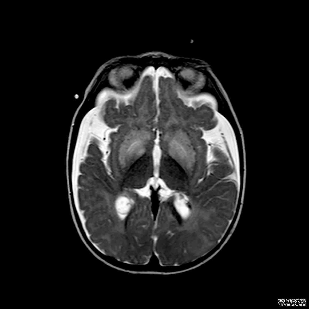 【病例】低血糖性脑病1例MR影像-9
