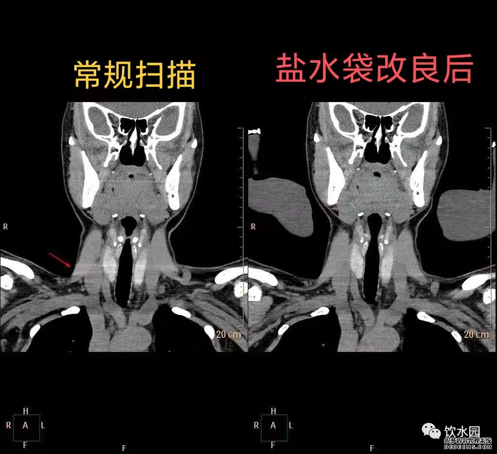 盐水袋可去除射线束硬化伪影-3