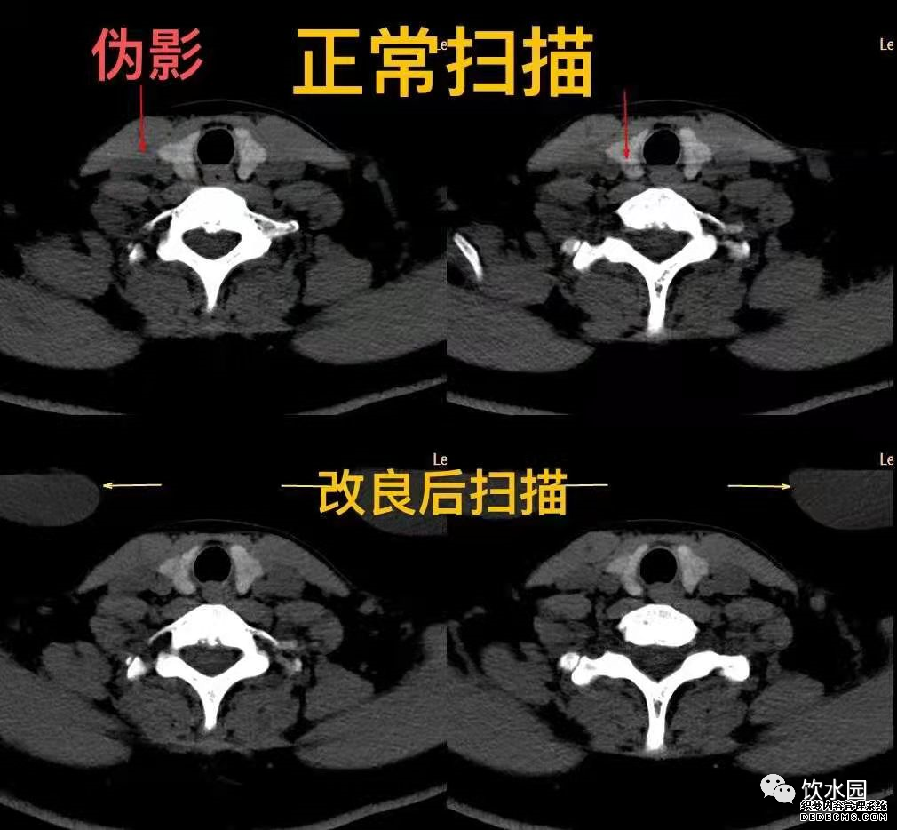 盐水袋可去除射线束硬化伪影-2