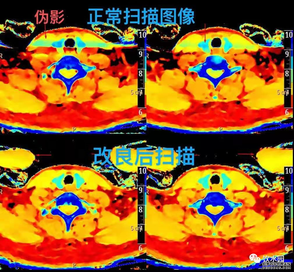 盐水袋可去除射线束硬化伪影-4