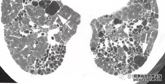 肺含气囊腔分类、定义及CT诊断思维-15 肺含气囊腔分类、定义及CT诊断思维-15