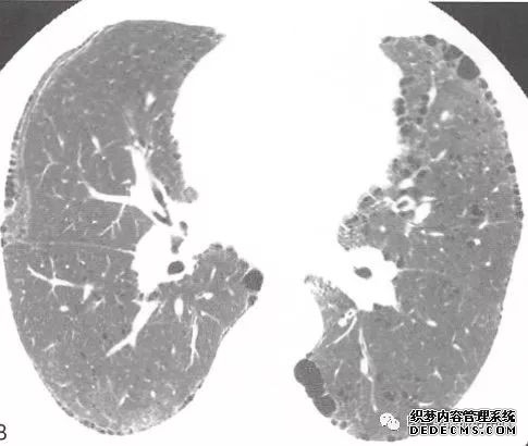 肺含气囊腔分类、定义及CT诊断思维-19
