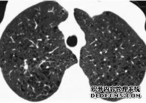 肺含气囊腔分类、定义及CT诊断思维-16 肺含气囊腔分类、定义及CT诊断思维-16