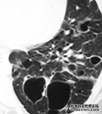 肺含气囊腔分类、定义及CT诊断思维-23 肺含气囊腔分类、定义及CT诊断思维-23