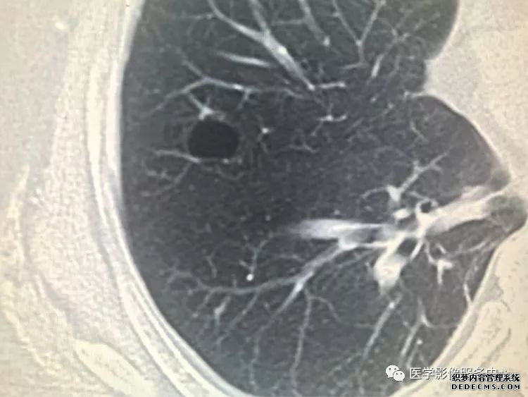 肺含气囊腔分类、定义及CT诊断思维-6 肺含气囊腔分类、定义及CT诊断思维-6