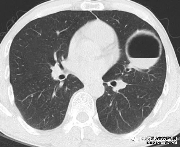 肺含气囊腔分类、定义及CT诊断思维-4