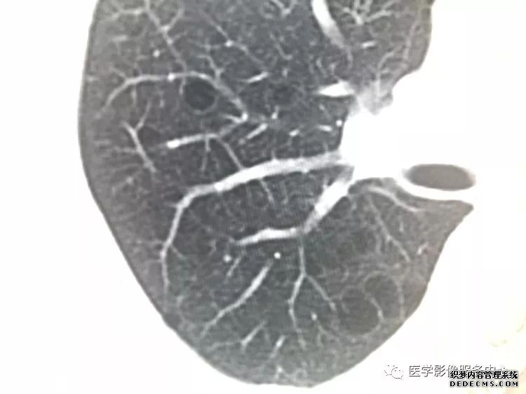 肺含气囊腔分类、定义及CT诊断思维-5 肺含气囊腔分类、定义及CT诊断思维-5