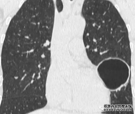 肺含气囊腔分类、定义及CT诊断思维-3 肺含气囊腔分类、定义及CT诊断思维-3