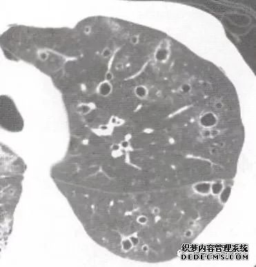 肺含气囊腔分类、定义及CT诊断思维-13 肺含气囊腔分类、定义及CT诊断思维-13