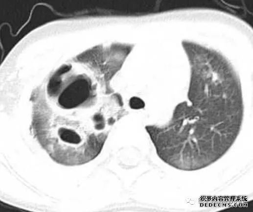 肺含气囊腔分类、定义及CT诊断思维-10 肺含气囊腔分类、定义及CT诊断思维-10