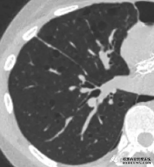 肺含气囊腔分类、定义及CT诊断思维-20