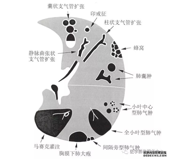 肺含气囊腔分类、定义及CT诊断思维-2 肺含气囊腔分类、定义及CT诊断思维-2
