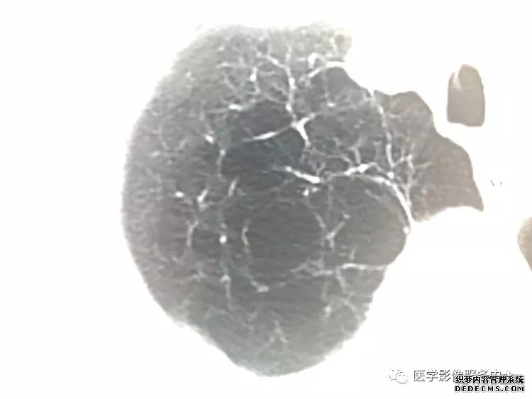 肺含气囊腔分类、定义及CT诊断思维-9 肺含气囊腔分类、定义及CT诊断思维-9