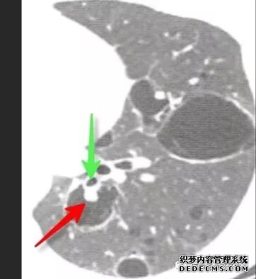 肺含气囊腔分类、定义及CT诊断思维-24 肺含气囊腔分类、定义及CT诊断思维-24
