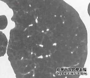 肺含气囊腔分类、定义及CT诊断思维-18 肺含气囊腔分类、定义及CT诊断思维-18