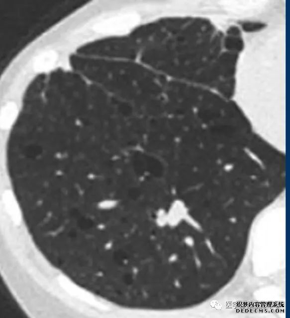 肺含气囊腔分类、定义及CT诊断思维-21