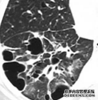 肺含气囊腔分类、定义及CT诊断思维-22