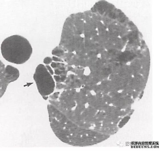 肺含气囊腔分类、定义及CT诊断思维-7 肺含气囊腔分类、定义及CT诊断思维-7