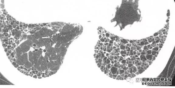 肺含气囊腔分类、定义及CT诊断思维-14