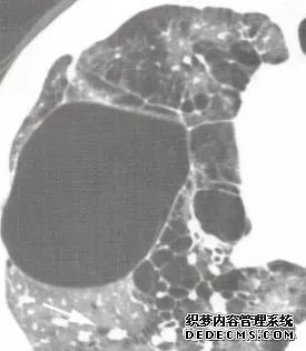 肺含气囊腔分类、定义及CT诊断思维-8 肺含气囊腔分类、定义及CT诊断思维-8