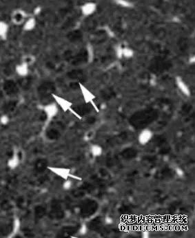 肺含气囊腔分类、定义及CT诊断思维-17 肺含气囊腔分类、定义及CT诊断思维-17