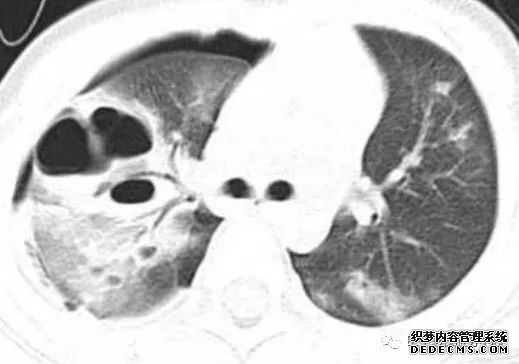 肺含气囊腔分类、定义及CT诊断思维-11