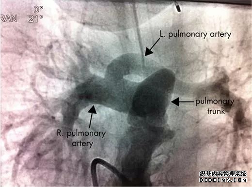 一起来认识肺动脉吊带的影像诊断与解剖模式-5