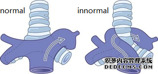 一起来认识肺动脉吊带的影像诊断与解剖模式-3