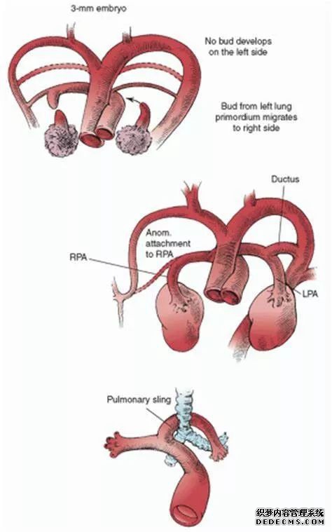 一起来认识肺动脉吊带的影像诊断与解剖模式-4