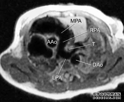 一起来认识肺动脉吊带的影像诊断与解剖模式-8