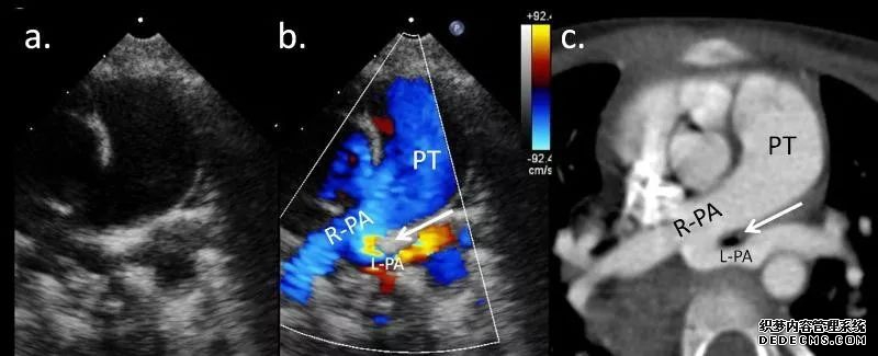 一起来认识肺动脉吊带的影像诊断与解剖模式-6