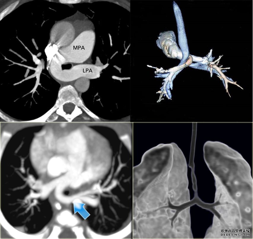 一起来认识肺动脉吊带的影像诊断与解剖模式-7