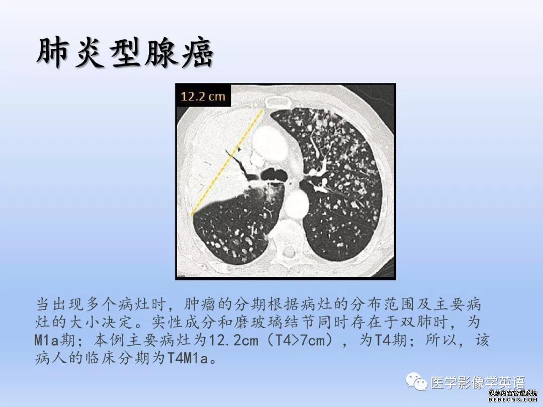 【PPT】肺腺癌TNM分期影像学解读-23