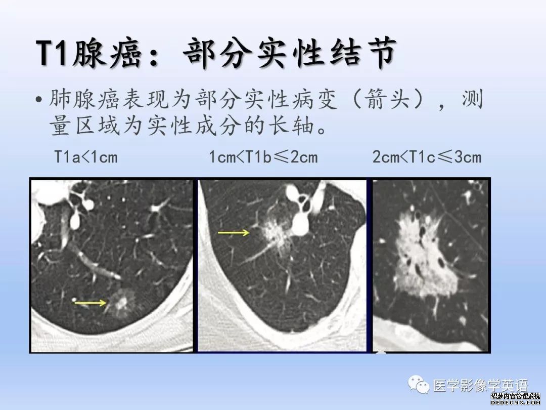 【PPT】肺腺癌TNM分期影像学解读-11