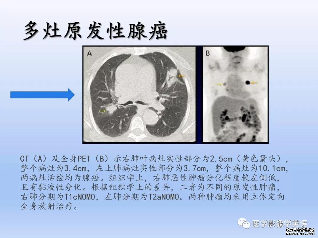 【PPT】肺腺癌TNM分期影像学解读-25