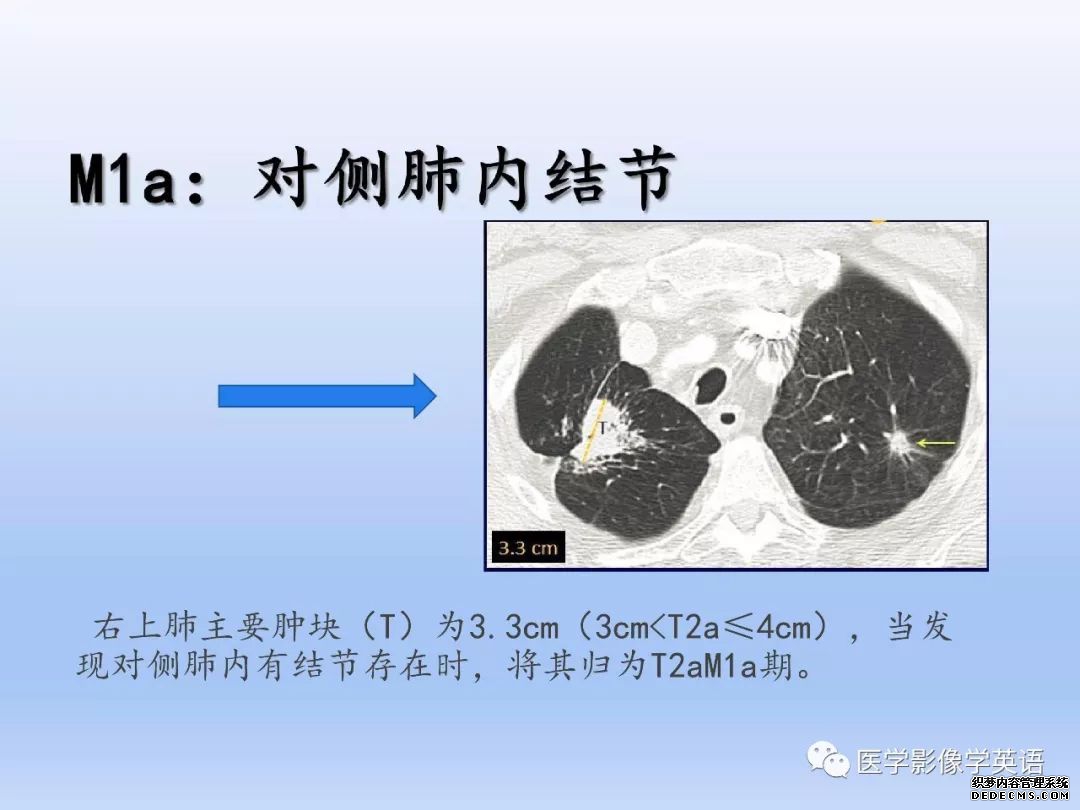 【PPT】肺腺癌TNM分期影像学解读-15