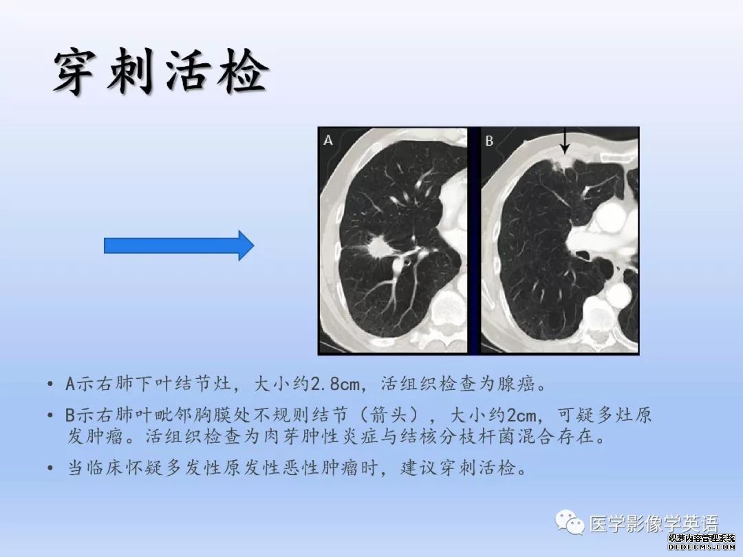 【PPT】肺腺癌TNM分期影像学解读-27