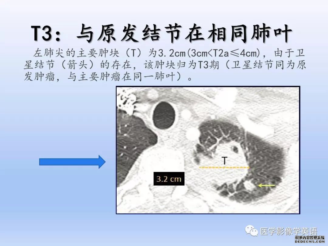【PPT】肺腺癌TNM分期影像学解读-13