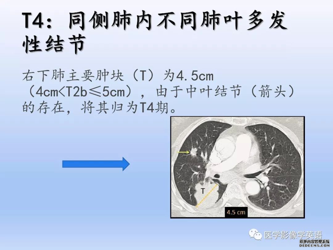 【PPT】肺腺癌TNM分期影像学解读-14