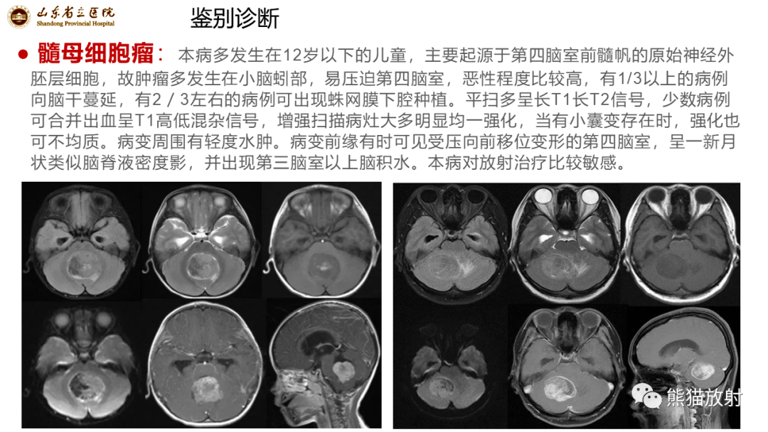 【病例】炎性肉芽肿并脓肿形成 & 成熟性囊性畸胎瘤-19
