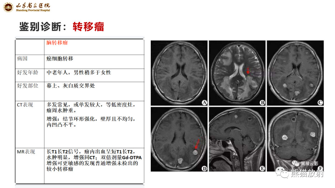 【病例】炎性肉芽肿并脓肿形成 & 成熟性囊性畸胎瘤-14