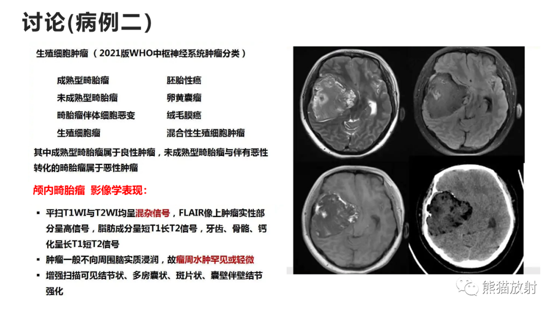 【病例】炎性肉芽肿并脓肿形成 & 成熟性囊性畸胎瘤-16
